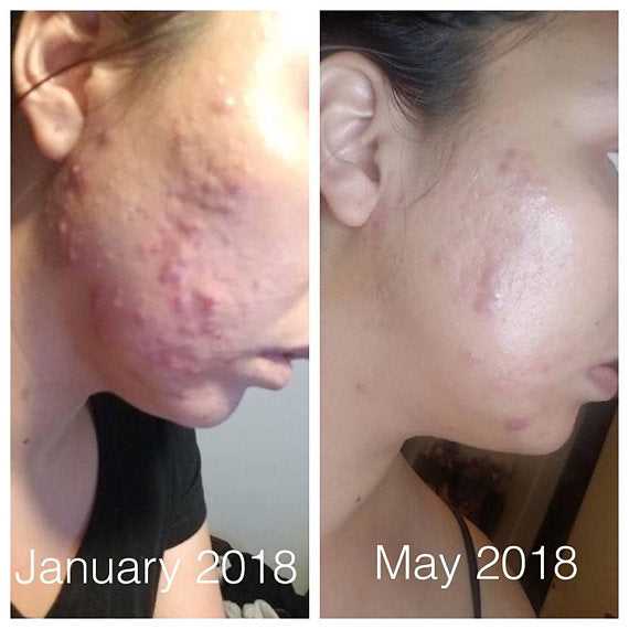 Super Organic Acne Fighter