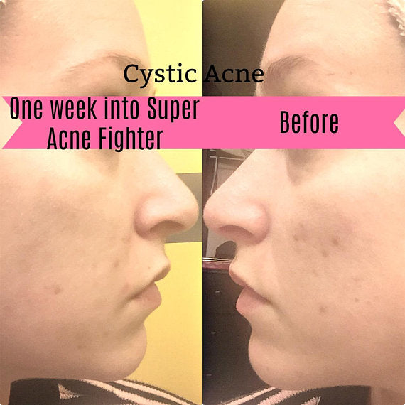 Super Organic Acne Fighter